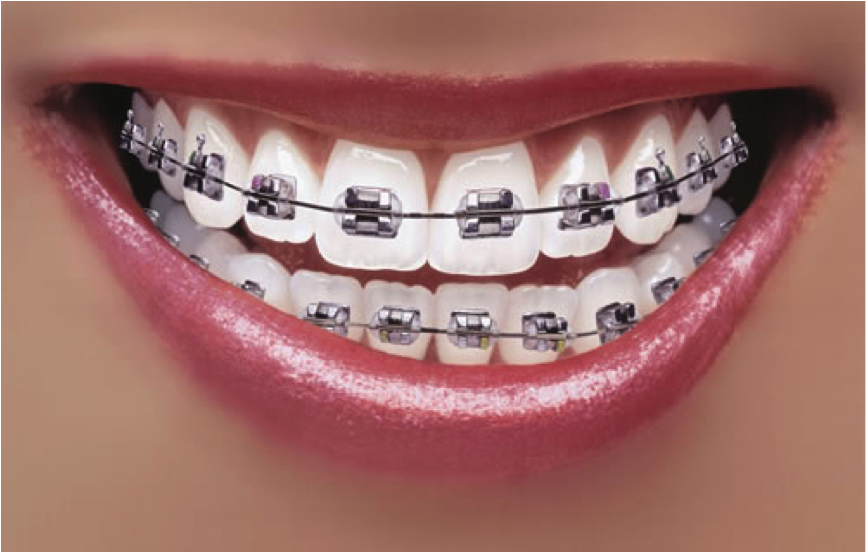 braces-smile