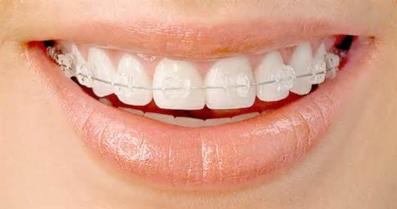 clearbraces